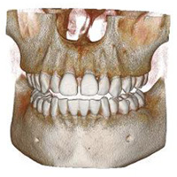 インプラント治療における歯科用CTのメリット